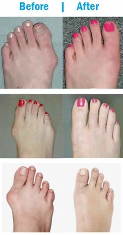 Bunion corrector Just For You