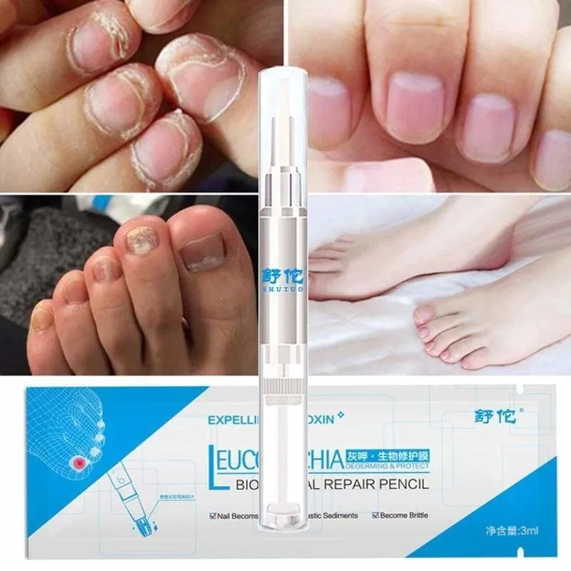 Fungal Nail Treatment Pen