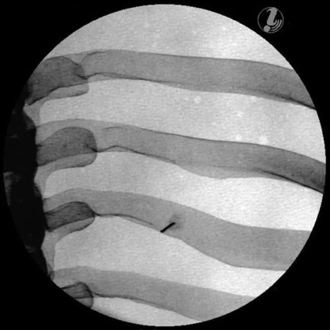 Image Guided Thoracic Spinal Injection Trainer