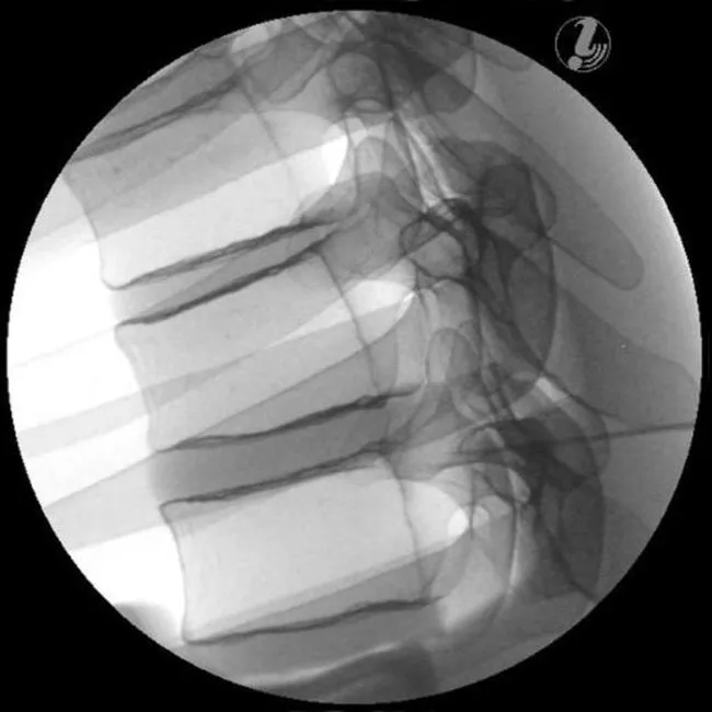 Image Guided Thoracic Spinal Injection Trainer