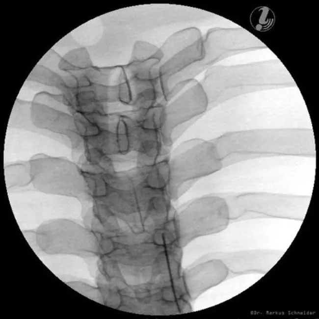 Image Guided Thoracic Spinal Injection Trainer